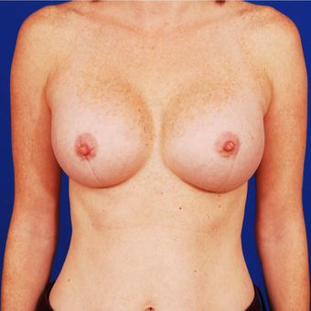25-34 year old woman treated with Breast Augmentation after 3742356