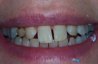 35-44 year old woman treated withDental Veneers before 3031459