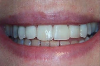 35-44 year old woman treated withDental Veneers after 3031459