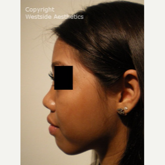 Radiesse Non Surgical Nose Job before 2977269