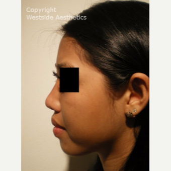 Radiesse Non Surgical Nose Job after 2977269