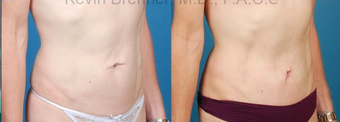 Mini Tummy Tuck with Diastasis Repair after 945619