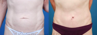 Mini Tummy Tuck with Diastasis Repair before 945619