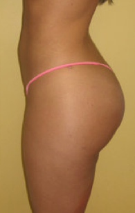 Buttock Augmentation 459487