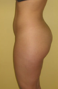Buttock Augmentation 459487