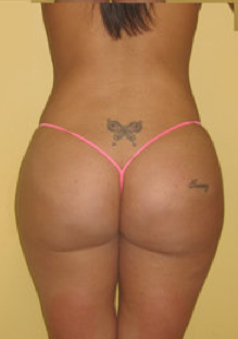 Buttock Augmentation after 459487