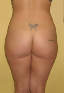 Buttock Augmentation before 459487