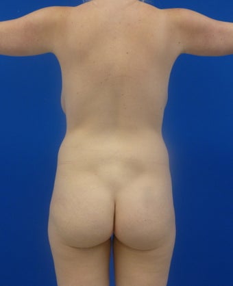 Brazilian Butt Lift before 893984