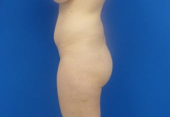 Brazilian Butt Lift 893984