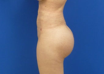 Brazilian Butt Lift 893984