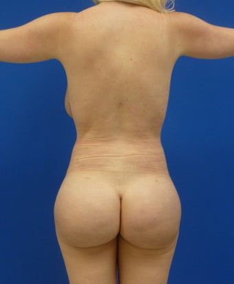 Brazilian Butt Lift after 893984