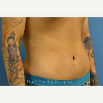 25-34 year old man treated with Male Tummy Tuck after 3368670