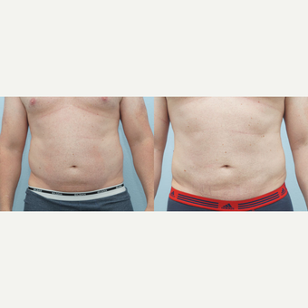 Liposuction 41 yr old Male before 3294507