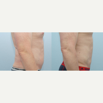 Liposuction 41 yr old Male after 3294507