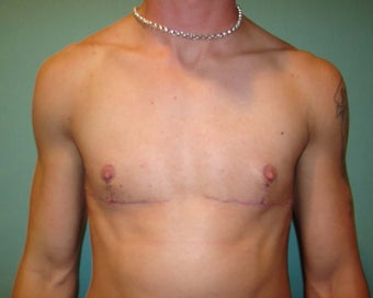 "Top Surgery" FTM chest masculinization after 867221