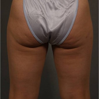 35-44 year old woman treated with CoolSculpting before 1683466