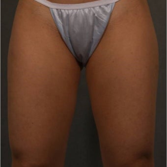 35-44 year old woman treated with CoolSculpting 1683466