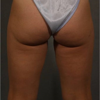 35-44 year old woman treated with CoolSculpting after 1683466