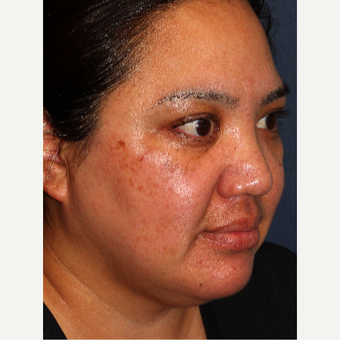 25-34 year old woman treated with Laser Treatment before 3220105