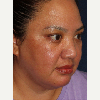 25-34 year old woman treated with Laser Treatment after 3220105