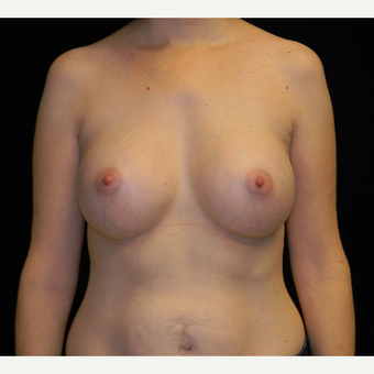 35-44 year old woman treated with Breast Augmentation with Ideal Implant after 3809005