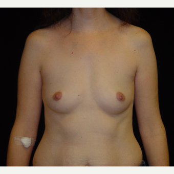 35-44 year old woman treated with Breast Augmentation with Ideal Implant before 3809005