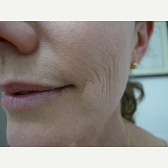 45-54 year old woman treated with Laser Resurfacing before 1545206