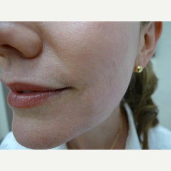 45-54 year old woman treated with Laser Resurfacing after 1545206