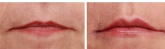 Lip enhancement with hyaluronic acid gel (Juvederm) before 1088291