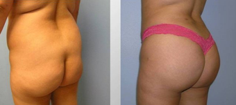Fat transfer buttock augmentation and liposuction before 163641