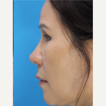 55-64 year old woman treated with Asian Rhinoplasty after 3507086