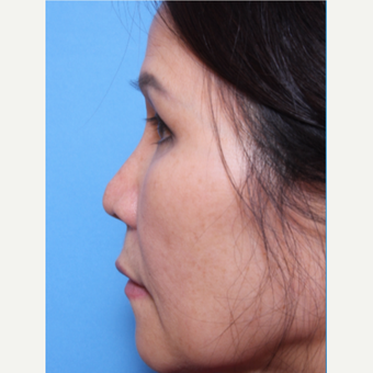 55-64 year old woman treated with Asian Rhinoplasty before 3507086