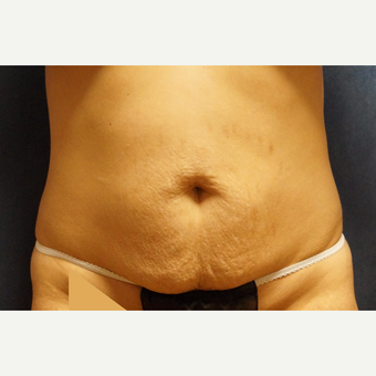 25-34 year old woman treated with Body Lift before 3071729