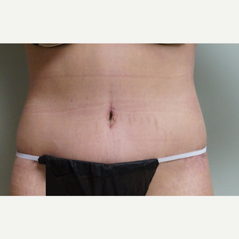 25-34 year old woman treated with Body Lift after 3071729