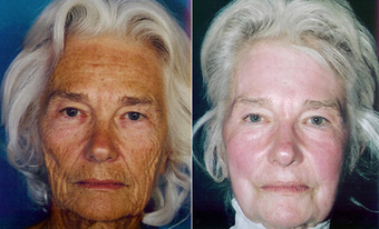 Chemical Peel before 1429290