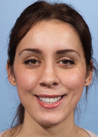Orthognathic Jaw Surgery after 986460