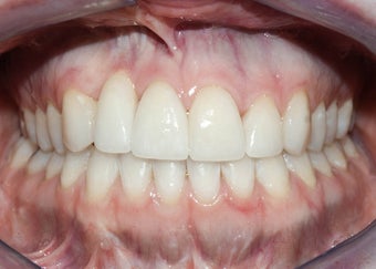 Orthognathic Jaw Surgery 986460