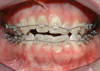 Orthognathic Jaw Surgery 986460