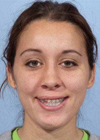 Orthognathic Jaw Surgery before 986460