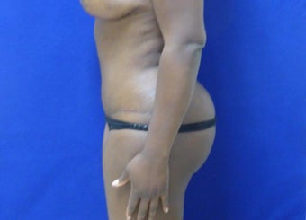 32 y.o. – female – Wise pattern mastopexy with abdominoplasty (mommy makeover) after 3401321