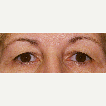 65-74 year old woman treated with Ear Lobe Surgery before 3441193