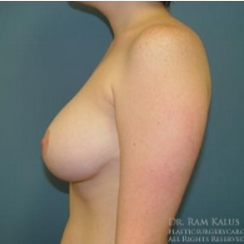 18-24 year old woman treated with Breast Reduction after 1711798