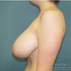 18-24 year old woman treated with Breast Reduction before 1711798