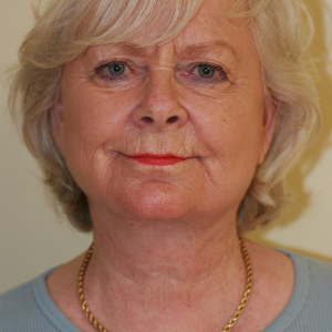 65-74 year old woman treated with Neck Lift after 3555286