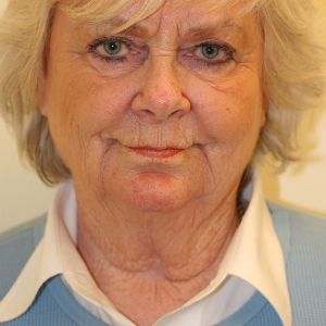 65-74 year old woman treated with Neck Lift before 3555286