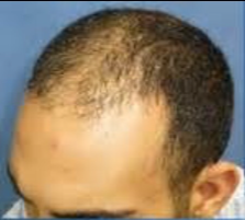 25-34 year old man treated with Hair Transplant before 3222733