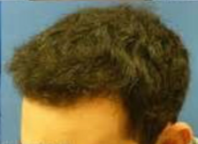 25-34 year old man treated with Hair Transplant after 3222733