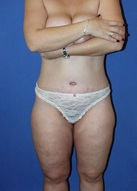 Thigh Lift after 1558000