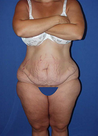 Thigh Lift before 1558000