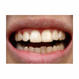 Chipped teeth treated with Dental Bonding after 3696681